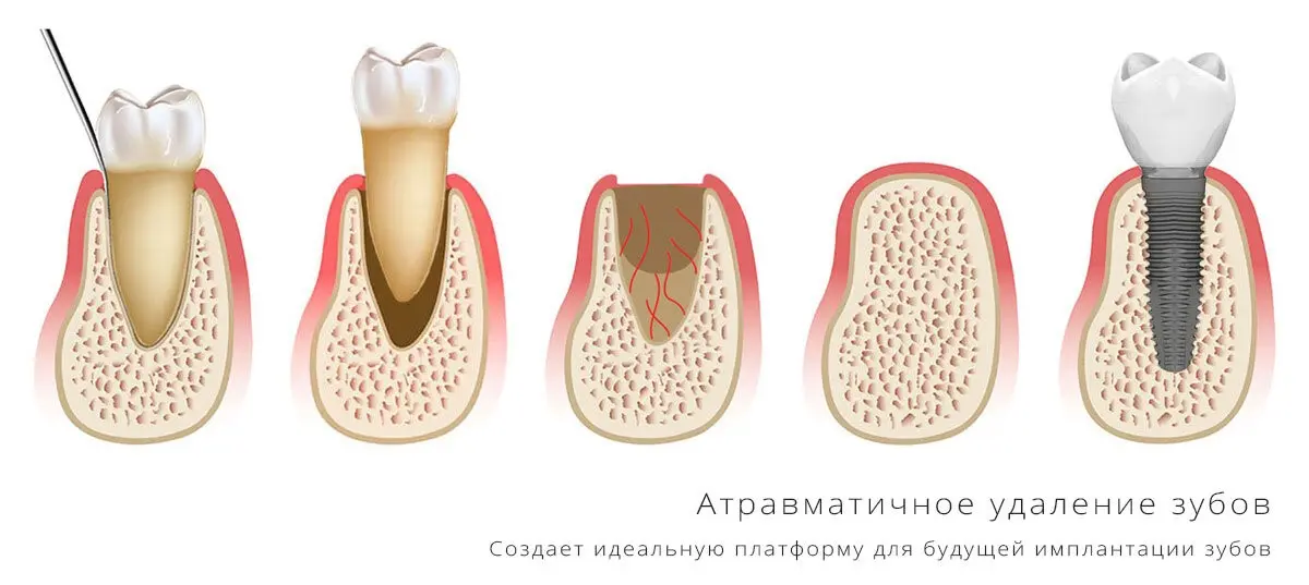 Перегородка у корня зуба.